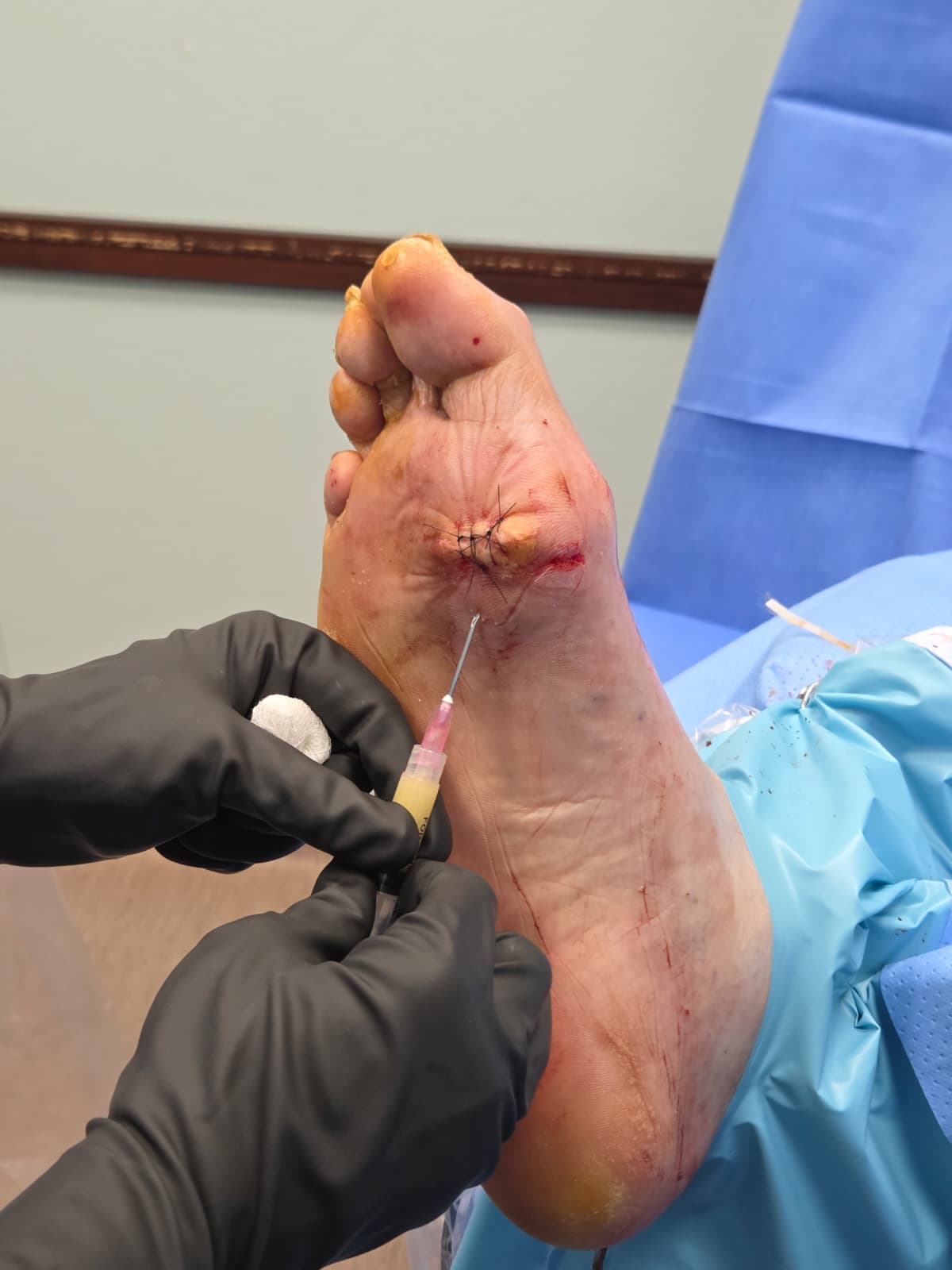Liposana fat pad restoration injection procedure